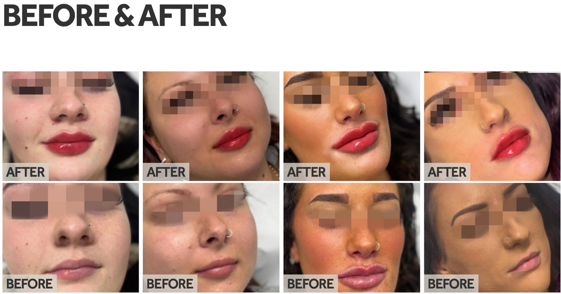 Lip Boosters, Lip Contouring Without Filling