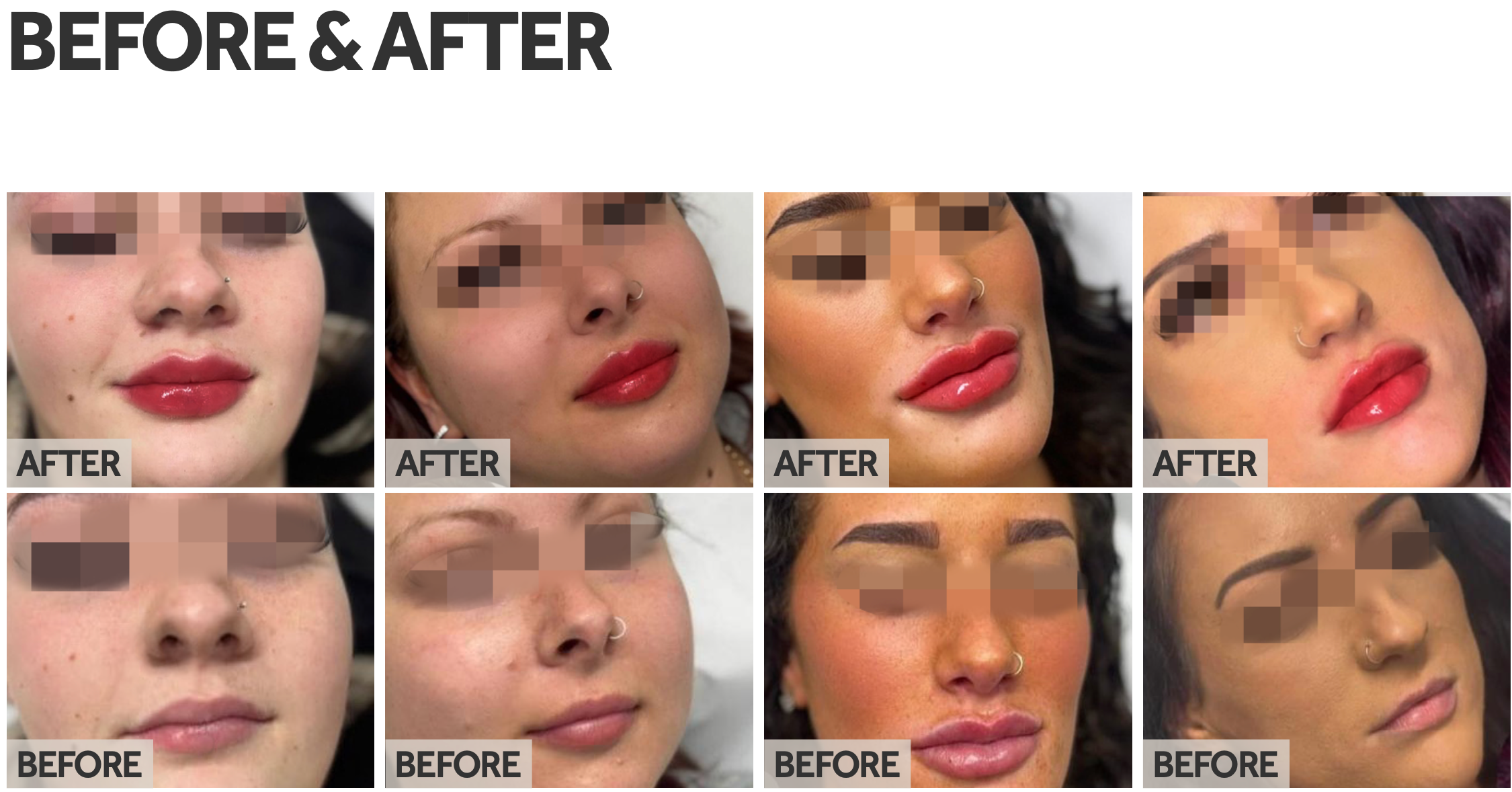 Lip Boosters, Lip Contouring Without Filling