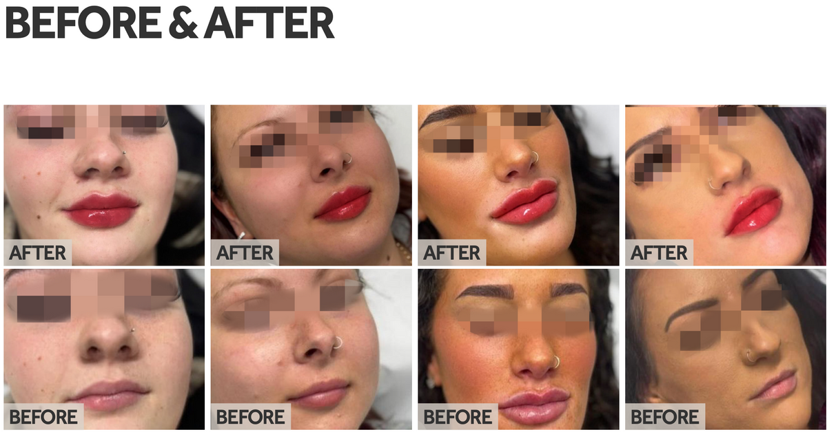 Lip Boosters, Lip Contouring Without Filling